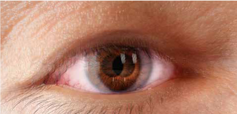 Diplopia